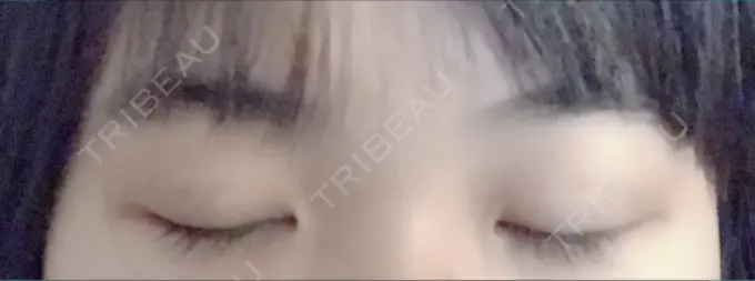 二重埋没 久留米総合美容外科 DAY 5 メイン用