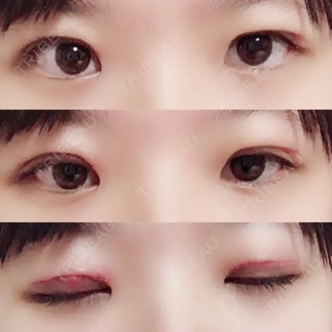 二重切開 / 上まぶたの脂肪取り 聖心美容クリニック 横浜院 DAY 7 メイン用