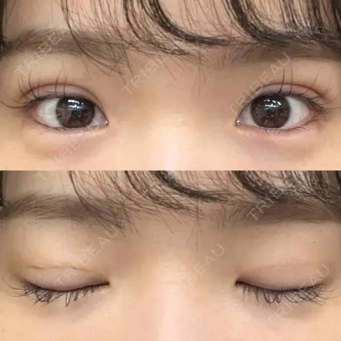 二重埋没 湘南美容クリニック 京都院 DAY 7 メイン用