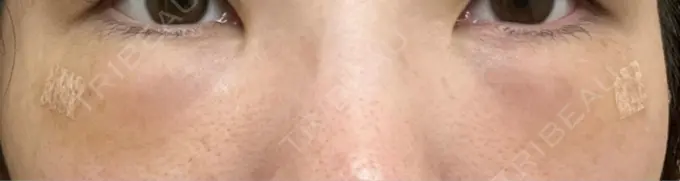 クマ治療 / 下まぶたの脂肪取り / 脂肪注入（目の下） / その他（目元） 東京シンデレラ美容外科 池袋院 DAY 2 メイン用