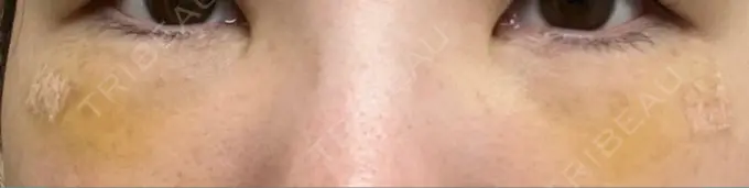 クマ治療 / 下まぶたの脂肪取り / 脂肪注入（目の下） / その他（目元） 東京シンデレラ美容外科 池袋院 DAY 4 メイン用