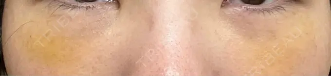 クマ治療 / 下まぶたの脂肪取り / 脂肪注入（目の下） / その他（目元） 東京シンデレラ美容外科 池袋院 DAY 7 メイン用