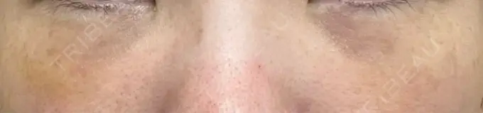 クマ治療 / 下まぶたの脂肪取り / 脂肪注入（目の下） / その他（目元） 東京シンデレラ美容外科 池袋院 DAY 11 メイン用