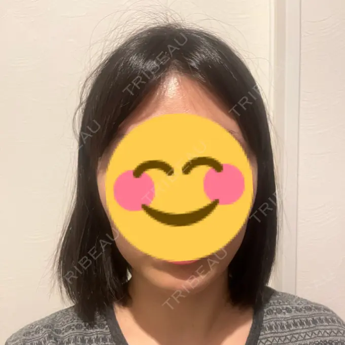 ボトックス（エラ・小顔） TCB東京中央美容外科 青森院 DAY 4 メイン用