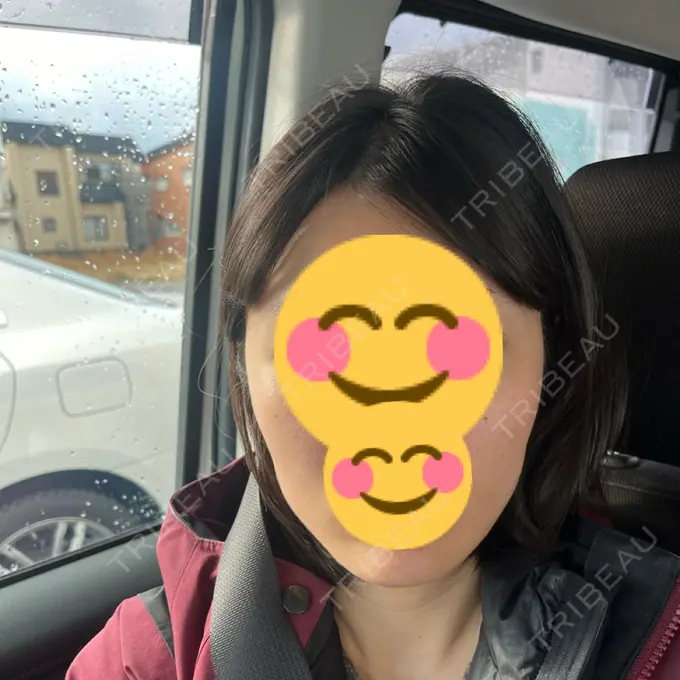 ボトックス（エラ・小顔） TCB東京中央美容外科 青森院 DAY 7 メイン用