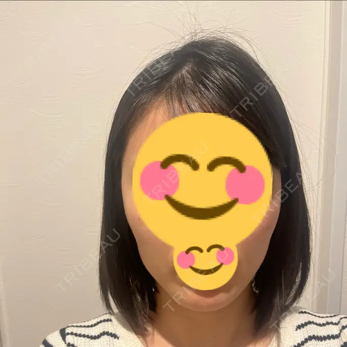 ボトックス（エラ・小顔） TCB東京中央美容外科 青森院 DAY 8 メイン用