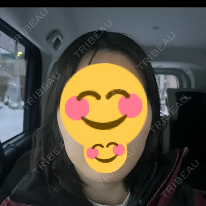 ボトックス（エラ・小顔） TCB東京中央美容外科 青森院 DAY 10 メイン用