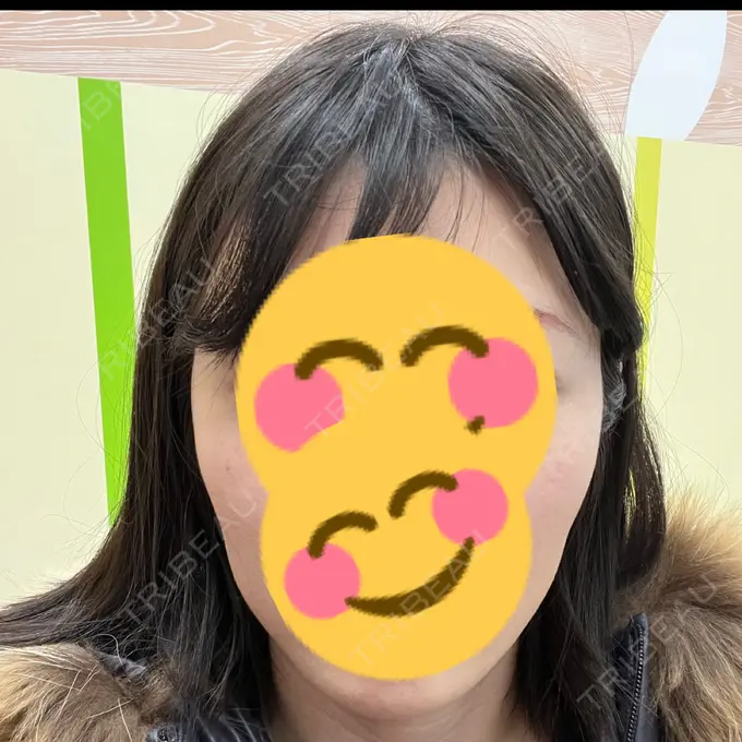 ボトックス（エラ・小顔） TCB東京中央美容外科 青森院 DAY 11 メイン用