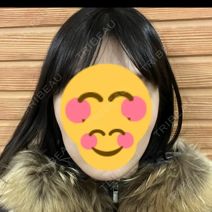 ボトックス（エラ・小顔） TCB東京中央美容外科 青森院 DAY 12 メイン用