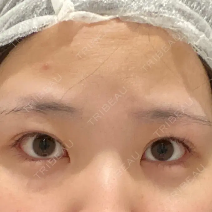 眼瞼下垂（非切開） SOL CLINIC DAY 0 メイン用