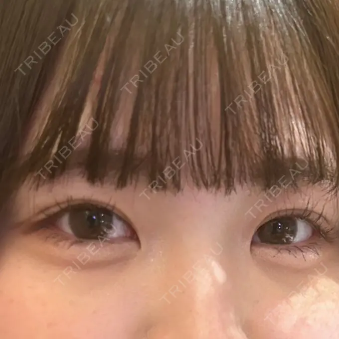 眼瞼下垂（非切開） SOL CLINIC AFTER メイン用