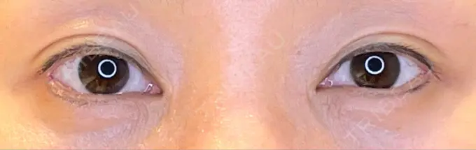 目尻切開 / タレ目形成・グラマラスライン（埋没） / 美容点滴・美容注射（美肌） LOUIS CLINIC 二子玉川院【ルイクリニック】 DAY 15 メイン用