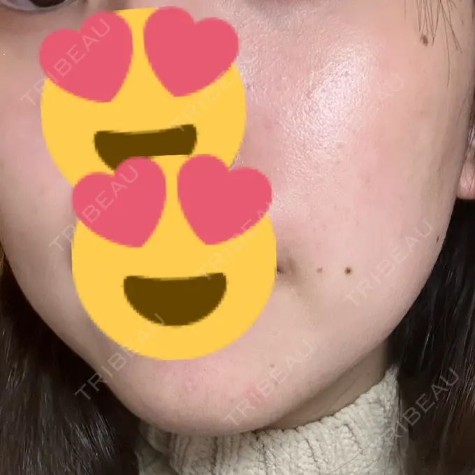 ほくろ・いぼ切除（肌） LIKI CLINIC KOBE AFTER メイン用