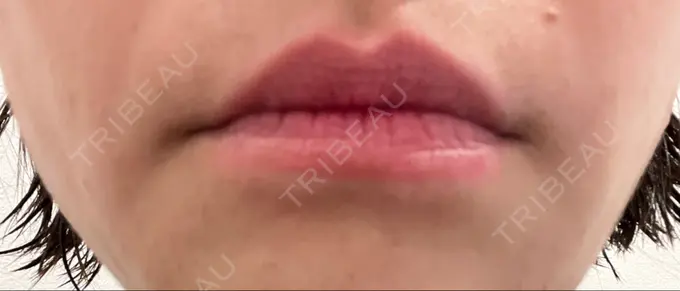 ボトックス（人中） veary clinic DAY 0 メイン用