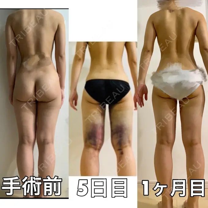 豊胸（脂肪注入） / 豊胸（ヒアルロン酸） 東京美容外科 梅田院 DAY 28 メイン用