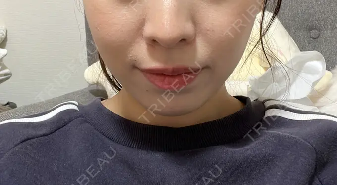 糸リフト / バッカルファット除去 / 脂肪吸引（顔） / ヒアルロン酸注入（あご） / ボトックス（エラ・小顔） RIVER CLINIC（リバークリニック） AFTER メイン用