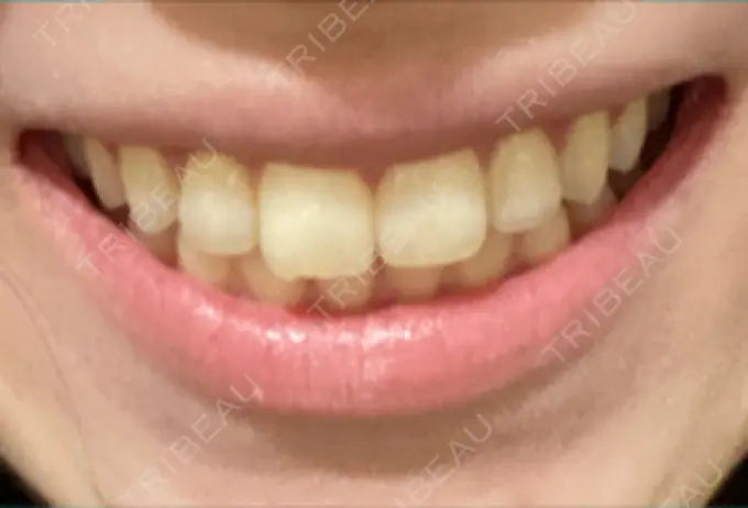 ホワイトニング オーラルビューティークリニック クラリス審美歯科・矯正歯科 DAY 2 メイン用