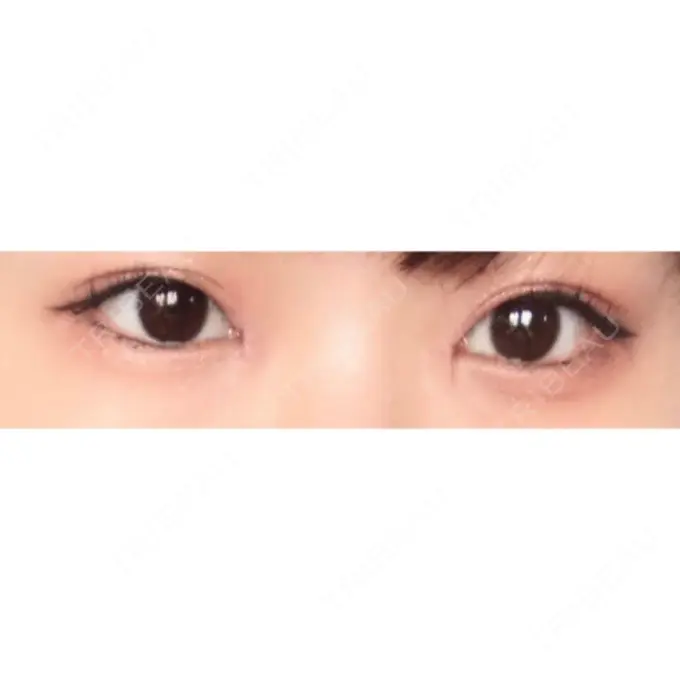 目頭切開 ラボム整形外科 DAY 10 メイン用