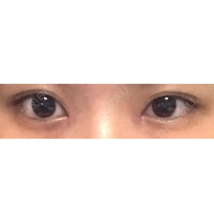 目頭切開 ラボム整形外科 DAY 12 メイン用