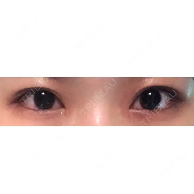 目頭切開 ラボム整形外科 DAY 15 メイン用