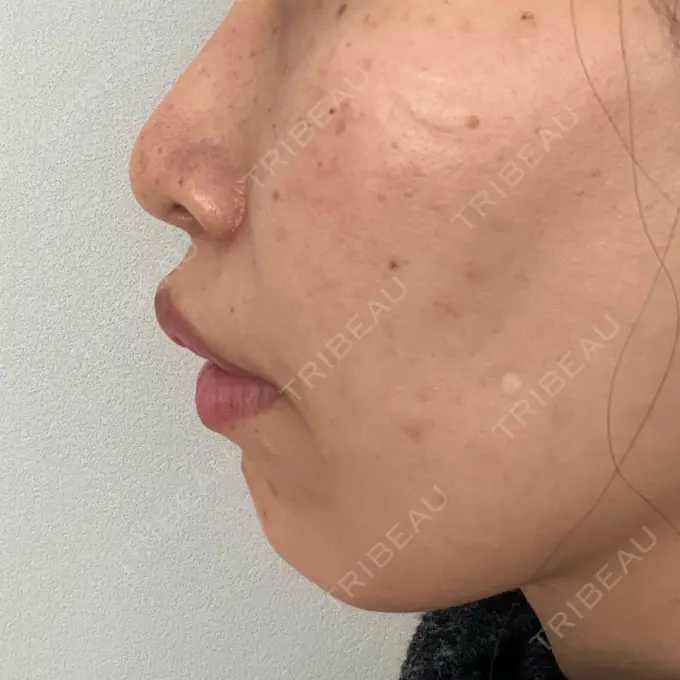 小鼻縮小（切開） / 人中短縮 / 鼻翼挙上 Otus Clinic 【オータスクリニック】 DAY 43 メイン用