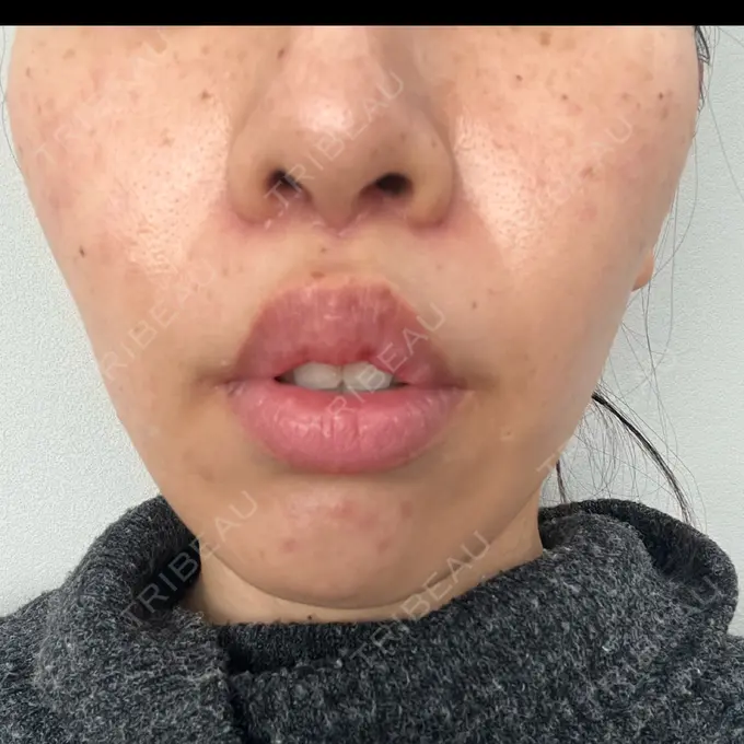 小鼻縮小（切開） / 人中短縮 / 鼻翼挙上 Otus Clinic 【オータスクリニック】 DAY 43 メイン用