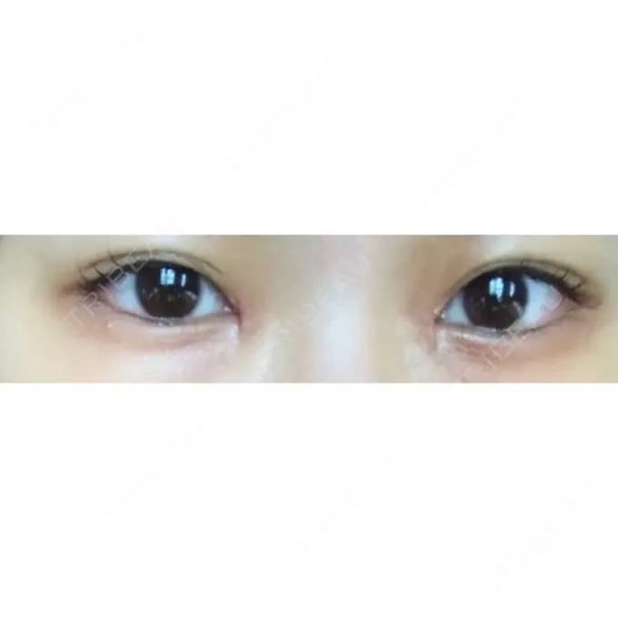 目頭切開 ラボム整形外科 DAY 16 メイン用