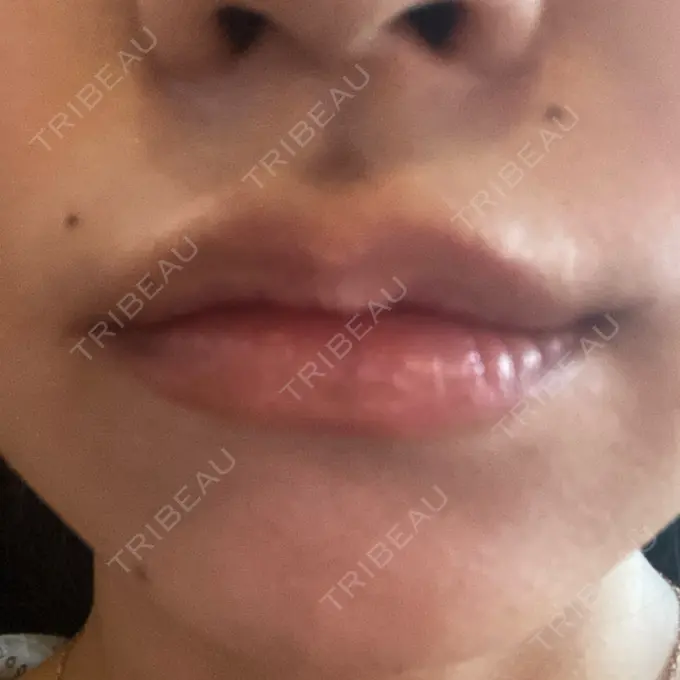 ヒアルロン酸注入（涙袋） / ヒアルロン酸注入（唇） ファイヤークリニック 名古屋院 DAY 1 メイン用