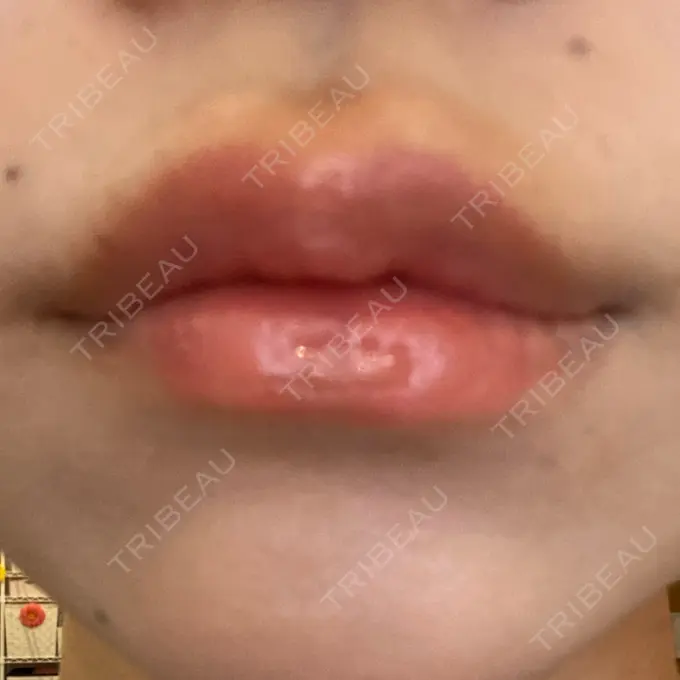 ヒアルロン酸注入（涙袋） / ヒアルロン酸注入（唇） ファイヤークリニック 名古屋院 AFTER メイン用