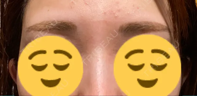 アートメイク（眉） 表参道メディカルクリニック 名古屋院 DAY 97 メイン用