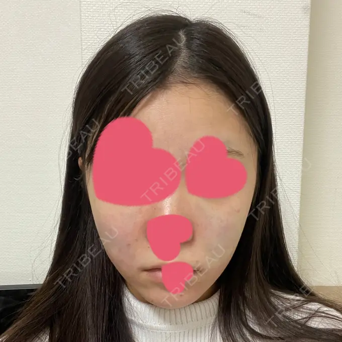 脂肪吸引（顔） / メーラーファット除去 / 脂肪吸引注射（顔） / その他（輪郭） 東京シンデレラ美容外科 池袋院 AFTER メイン用