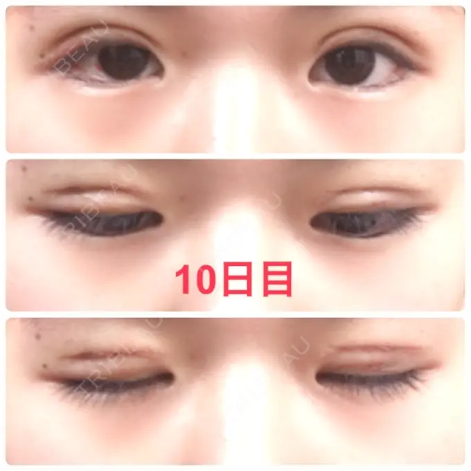 二重切開 品川スキンクリニック広島院 AFTER メイン用