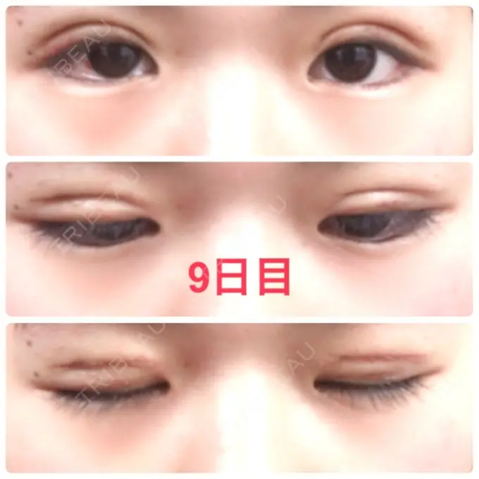 二重切開 品川スキンクリニック広島院 DAY 9 メイン用