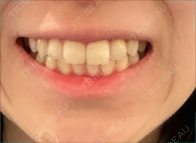 ホワイトニング オーラルビューティークリニック クラリス審美歯科・矯正歯科 DAY 3 メイン用