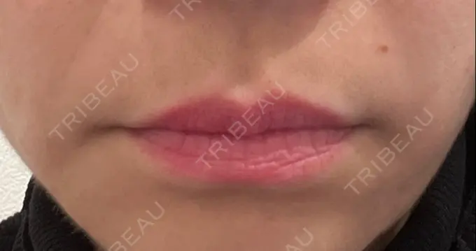 ボトックス（人中） veary clinic DAY 2 メイン用