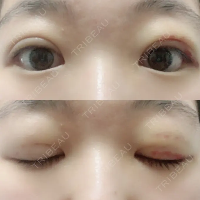 二重埋没 湘南美容クリニック 仙台院 DAY 9 メイン用