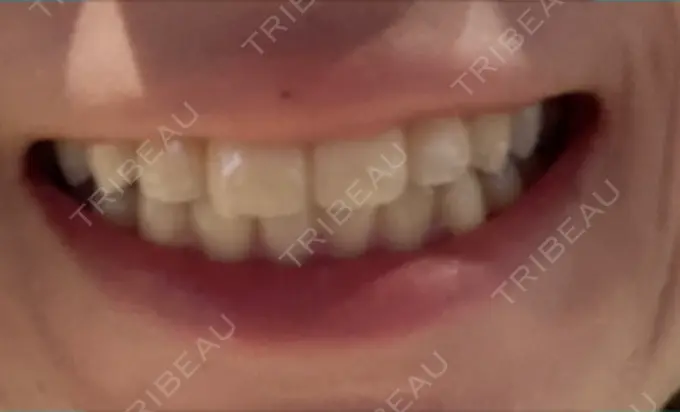 ホワイトニング オーラルビューティークリニック クラリス審美歯科・矯正歯科 DAY 4 メイン用