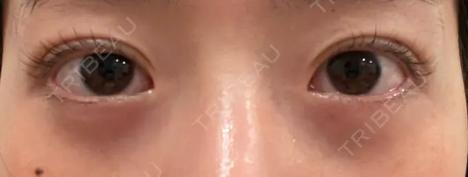 二重埋没 湘南美容クリニック 京都院 AFTER メイン用