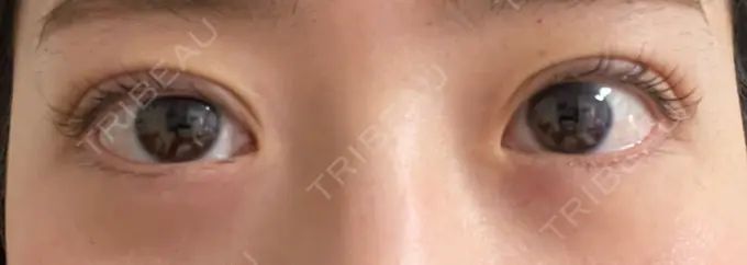 二重埋没 湘南美容クリニック 京都院 DAY 4 メイン用