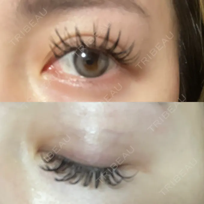 二重埋没 Brandnew Beauty Clinic DAY 33 メイン用