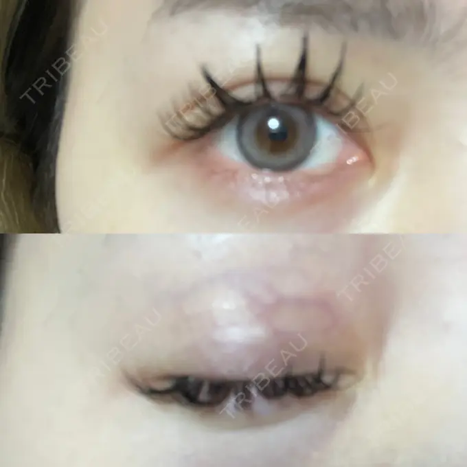 二重埋没 Brandnew Beauty Clinic DAY 33 メイン用