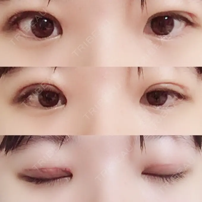 二重切開 / 上まぶたの脂肪取り 聖心美容クリニック 横浜院 DAY 8 メイン用