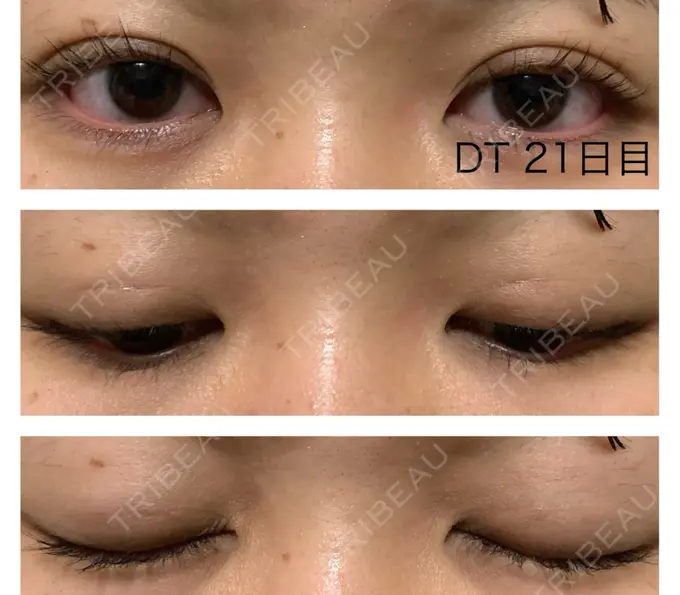 二重埋没 水の森美容クリニック 東京銀座院 DAY 21 メイン用