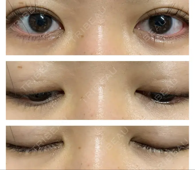 二重埋没 水の森美容クリニック 東京銀座院 DAY 28 メイン用