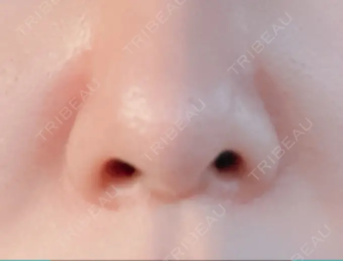 鼻尖形成（切開） / 鼻中隔延長（切開） / 鼻孔縁下降 / その他（目元） みずほクリニック AFTER メイン用