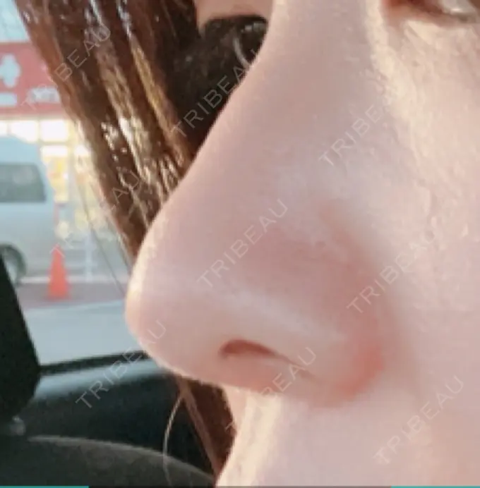 鼻尖形成（切開） / 鼻中隔延長（切開） / 鼻孔縁下降 / その他（目元） みずほクリニック DAY 314 メイン用