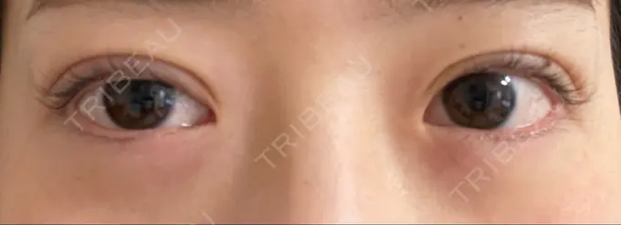 二重埋没 湘南美容クリニック 京都院 DAY 1 メイン用