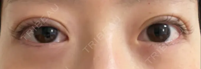 二重埋没 湘南美容クリニック 京都院 DAY 2 メイン用