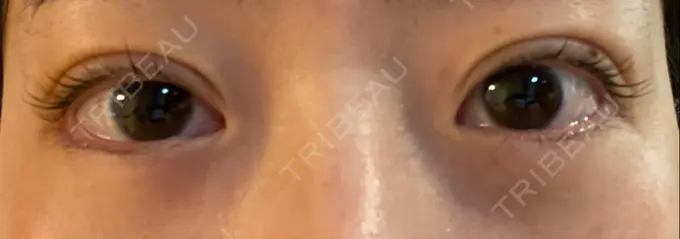 二重埋没 湘南美容クリニック 京都院 DAY 3 メイン用