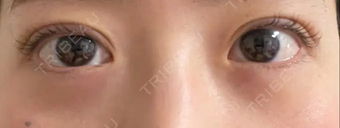 二重埋没 湘南美容クリニック 京都院 DAY 4 メイン用